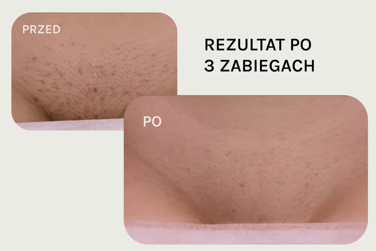 Bikini, po 3 zabiegach, przed i po depilacji laserowej
