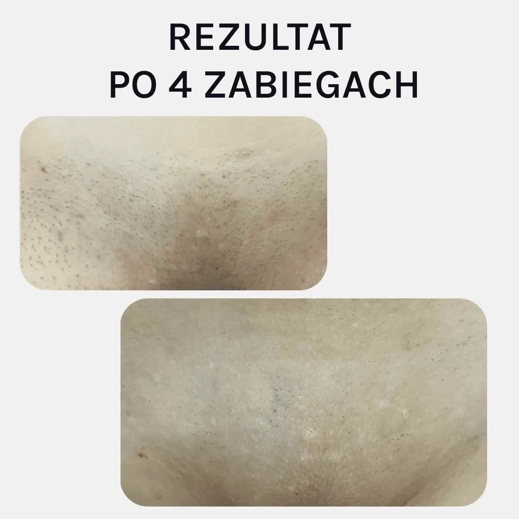 Bikini, po 4 zabiegach, przed i po depilacji laserowej