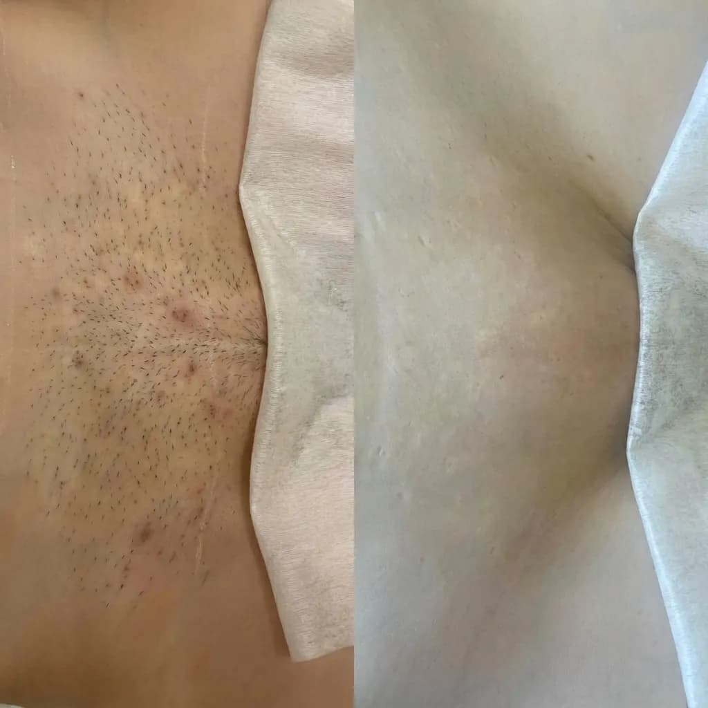 Bikini, przed i po depilacji laserowej
