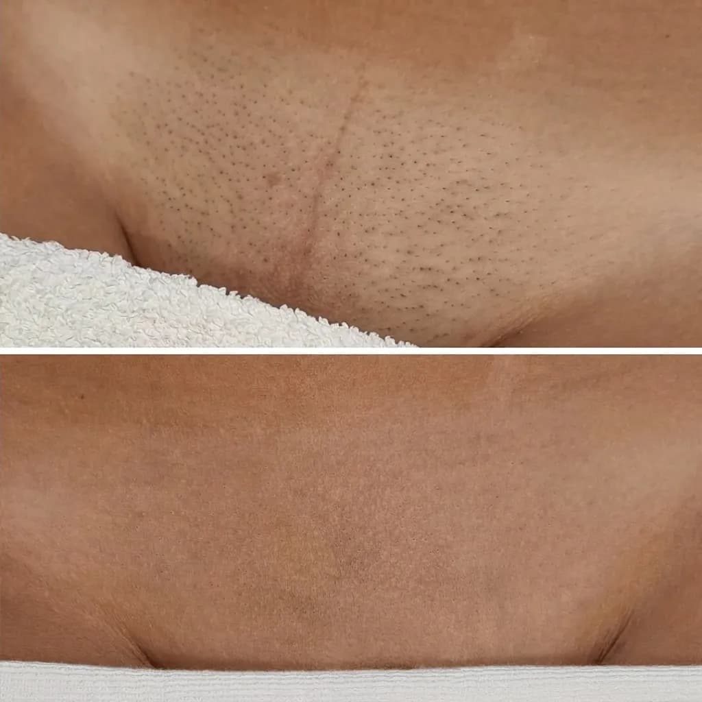 Bikini, przed i po depilacji laserowej