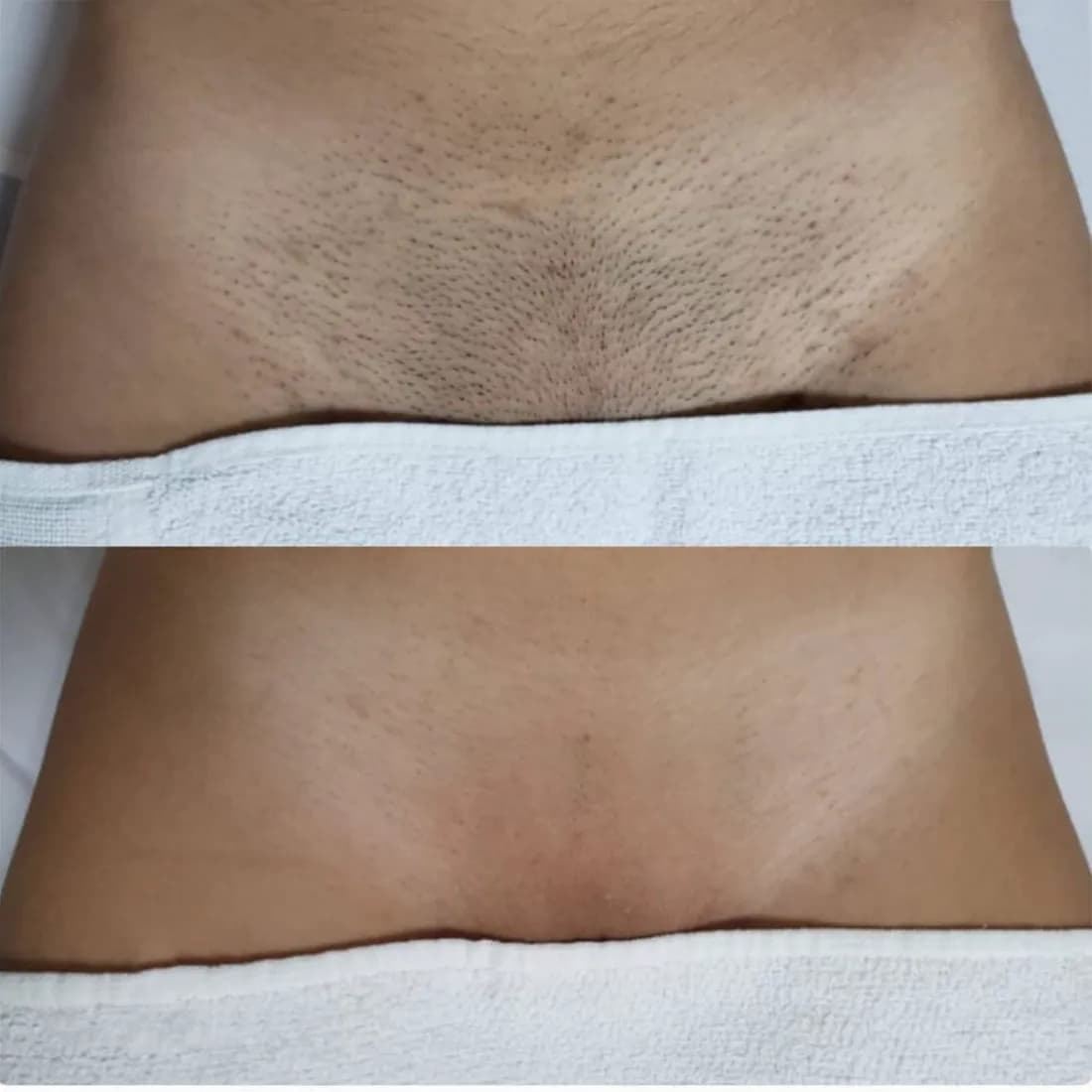 Bikini, przed i po depilacji laserowej
