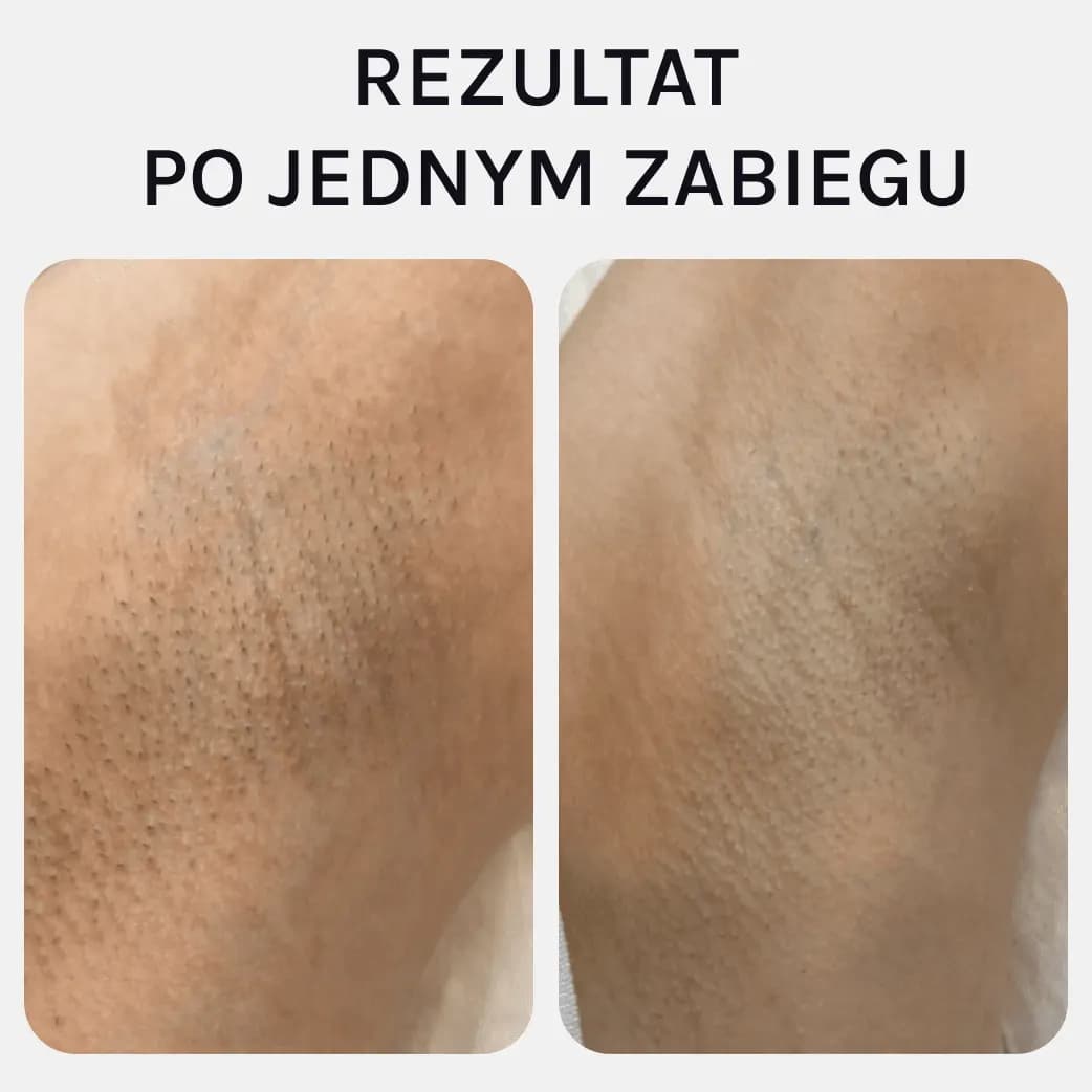 Pachy, po 1 zabiegu, przed i po depilacji laserowej