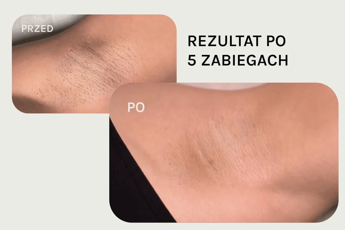Pachy, po 5 zabiegach, przed i po depilacji laserowej